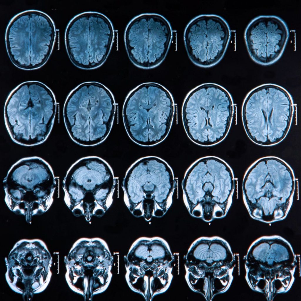 Best Brain Stroke Hospital in Patna